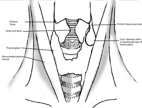 sinus piriformis|Pyriform Sinus